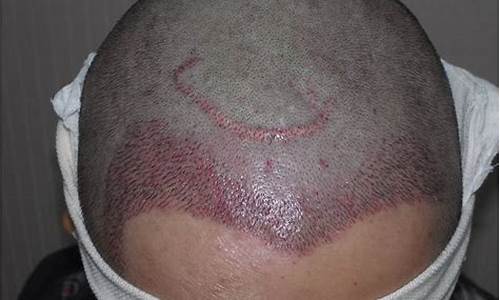 植发(植发一般能维持几年)_https://www.heiljjianzu.com_上交所_第1张